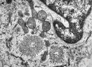 M,33y. | blood - hairy cell leukemia- ribosome-lamella complexin tricholeukocyte M,33y. | blood - hairy cell leukemia- ribosome-lamella complexin tricholeukocyte